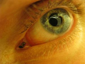 This is sometimes what happens to gnats which feed on eye exudates. It's a routine job hazard for people like Nancy and I.